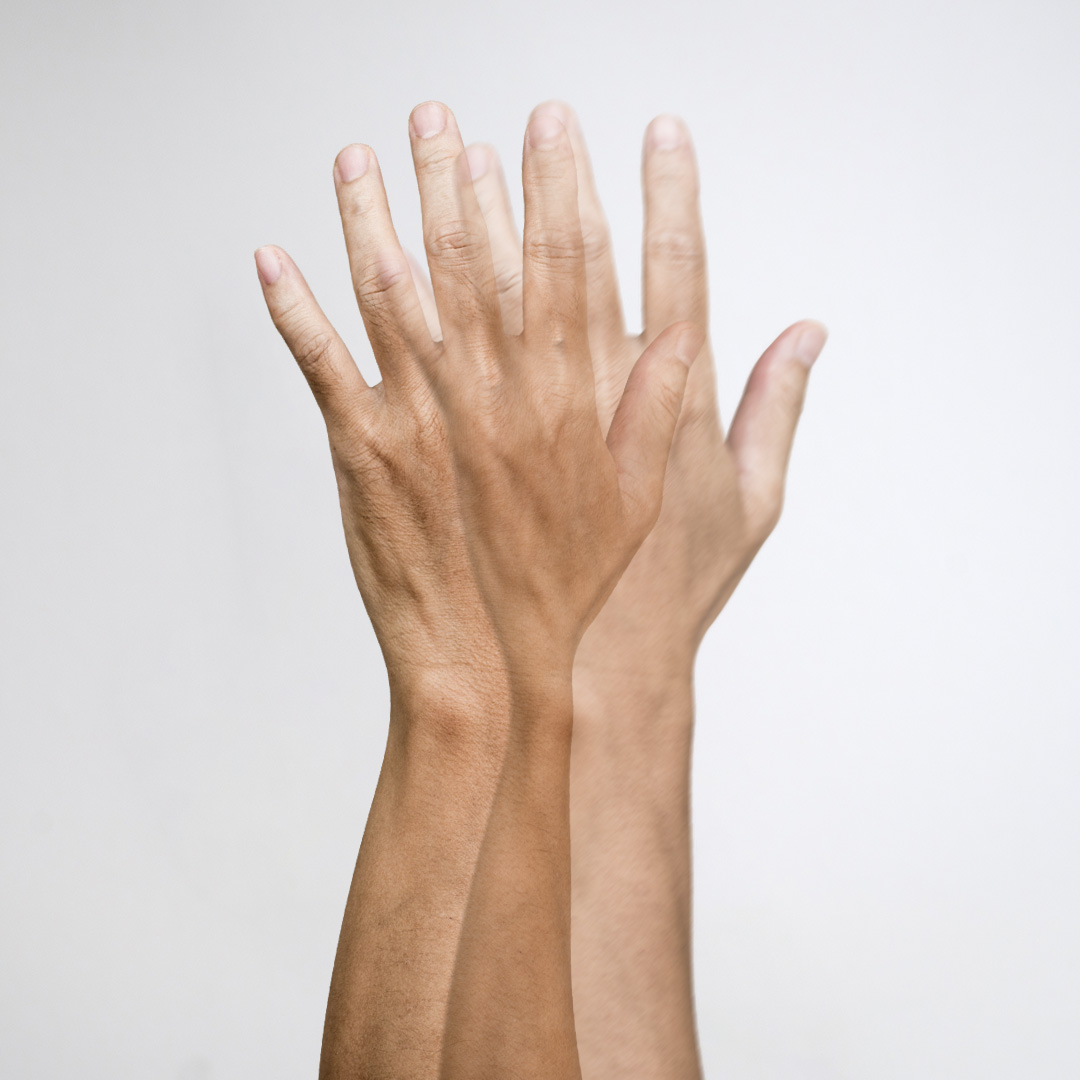 monokulinis dvejinimasis akyse