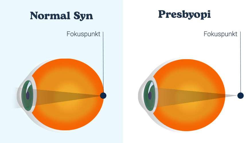 normalios akies ir akies su presbiopija fokusavimo taško vaizdas