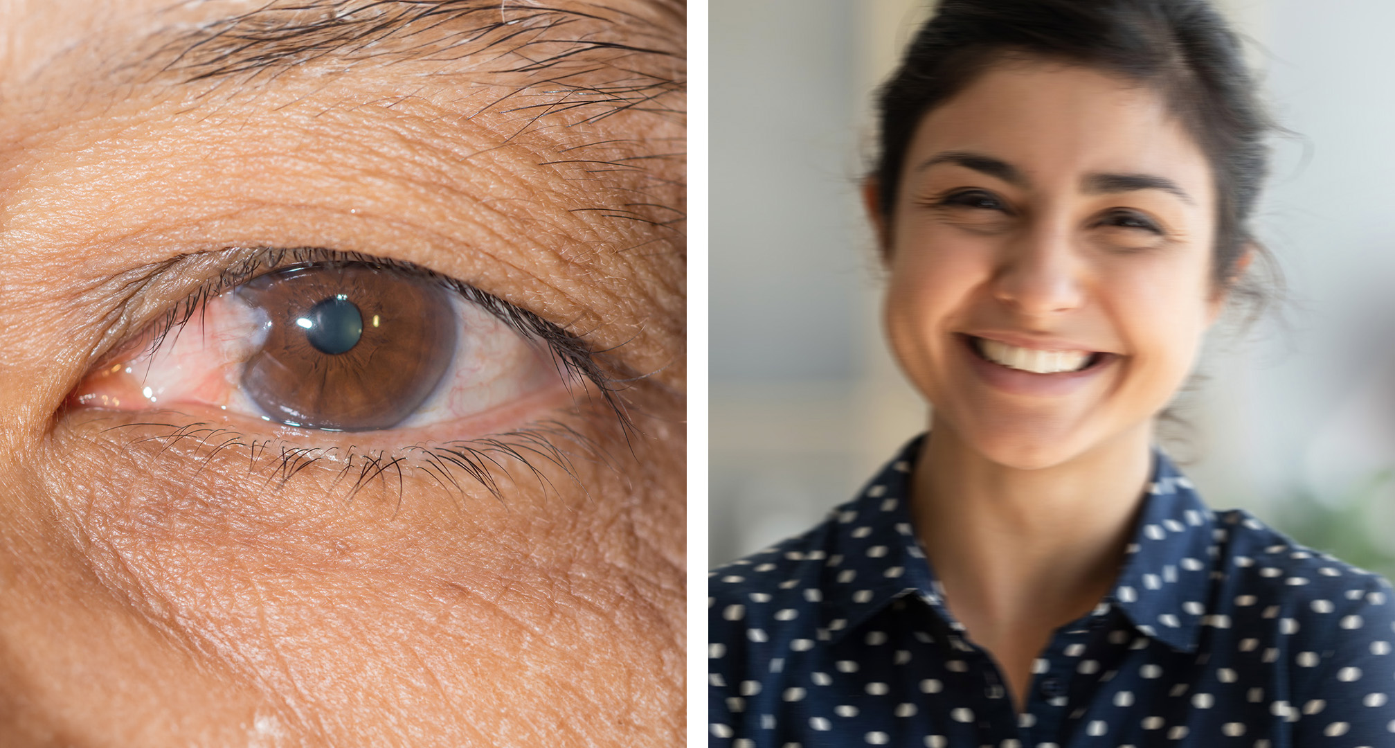 Pterygium yra pleišto formos išaugimas ant junginės, kuris plinta į rageną (kairėje). Kraštutiniais atvejais, jei pterygiumas išplinta per vyzdį, jis gali trukdyti arba aptemdyti regėjimą (dešinėje).